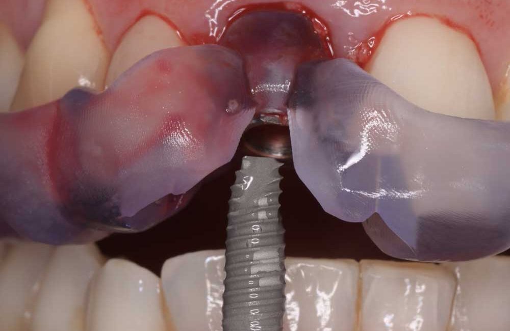 implant-cdv-image2