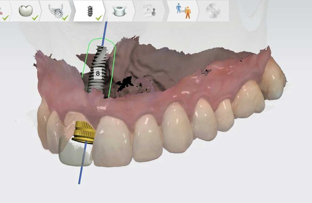 prothese-dentaire-3d-image3